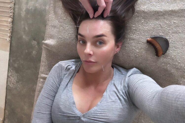 Beauty Acupuncture: The place Magnificence Meets Stability