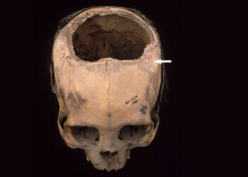 How the Incas Carried out Cranium Surgical procedure Extra Efficiently Than U.S. Civil Conflict Docs