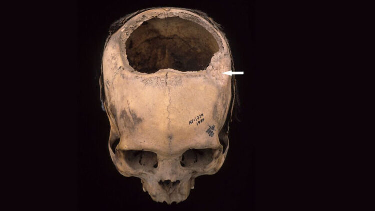 How the Incas Carried out Cranium Surgical procedure Extra Efficiently Than U.S. Civil Conflict Docs