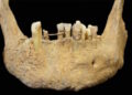 Oldest instance of restorative dentistry in Scotland present in parish church bone – The Historical past Weblog