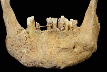 Oldest instance of restorative dentistry in Scotland present in parish church bone – The Historical past Weblog